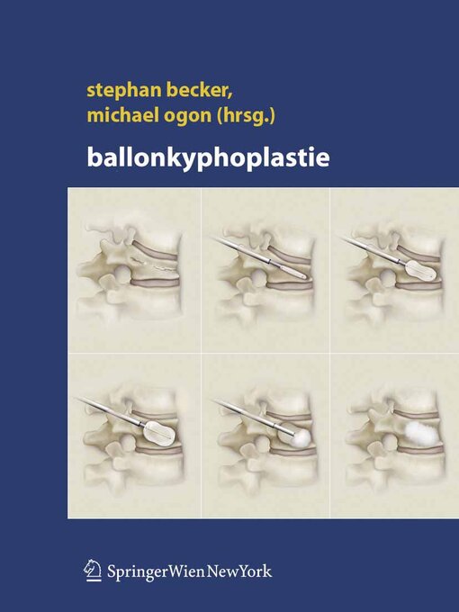 Title details for Ballonkyphoplastie by Stephan Becker - Wait list
